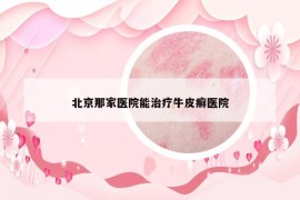 北京那家醫(yī)院能治療牛皮癬醫(yī)院