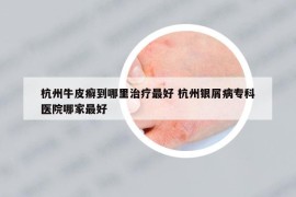 杭州牛皮癬到哪里治療最好 杭州銀屑病專科醫(yī)院哪家最好
