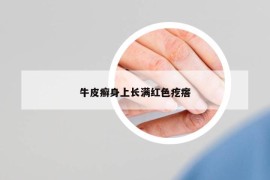 牛皮癬身上長滿紅色疙瘩