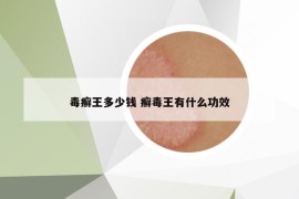 毒癬王多少錢 癬毒王有什么功效