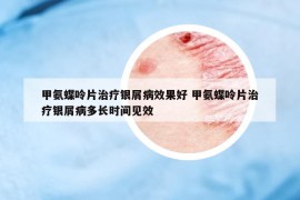 甲氨蝶呤片治療銀屑病效果好 甲氨蝶呤片治療銀屑病多長時間見效