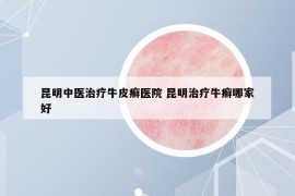 昆明中醫(yī)治療牛皮癬醫(yī)院 昆明治療牛癬哪家好
