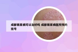 成都銀屑病可以治好嗎 成都銀屑病醫(yī)院預(yù)約掛號(hào)