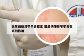銀屑病使用芐星青霉素 銀屑病使用芐星青霉素的作用