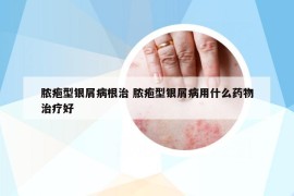 膿皰型銀屑病根治 膿皰型銀屑病用什么藥物治療好