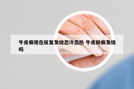 牛皮癬現(xiàn)在反復(fù)發(fā)燒忽冷忽熱 牛皮膚癬發(fā)燒嗎