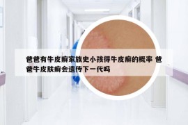 爸爸有牛皮癬家族史小孩得牛皮癬的概率 爸爸牛皮膚癬會遺傳下一代嗎