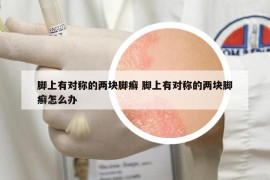 腳上有對稱的兩塊腳癬 腳上有對稱的兩塊腳癬怎么辦