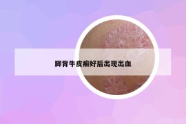 腳背牛皮癬好后出現(xiàn)出血