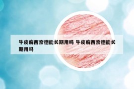 牛皮癬西奈德能長期用嗎 牛皮癬西奈德能長期用嗎