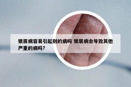 銀屑病容易引起別的病嗎 銀屑病會(huì)導(dǎo)致其他嚴(yán)重的病嗎?