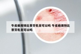 牛皮癬用特比萘芬乳膏可以嗎 牛皮癬用特比萘芬乳膏可以嗎