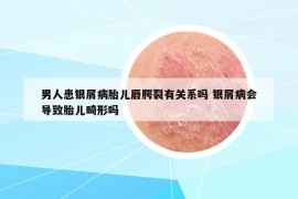 男人患銀屑病胎兒唇腭裂有關(guān)系嗎 銀屑病會導(dǎo)致胎兒畸形嗎