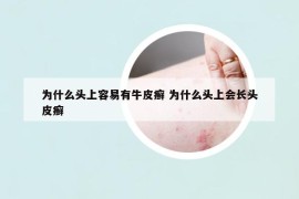 為什么頭上容易有牛皮癬 為什么頭上會長頭皮癬