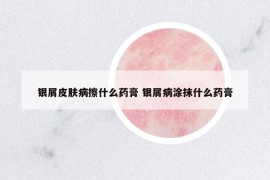 銀屑皮膚病擦什么藥膏 銀屑病涂抹什么藥膏