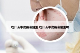 吃什么牛皮癬會(huì)加重 吃什么牛皮癬會(huì)加重呢