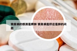 銀屑病的根源是脾肺 銀屑病是肝還是肺的問(wèn)題