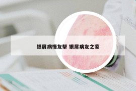 銀屑病慢友幫 銀屑病友之家
