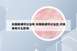 白顛瘋病可以治嗎 白顛瘋病可以治愈,對身體有什么影響