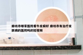 廊坊市哪家醫(yī)院看牛皮癬好 廊坊市有治療皮膚病的醫(yī)院嗎的短視頻