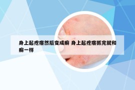 身上起疙瘩然后變成癬 身上起疙瘩抓完就和癬一樣
