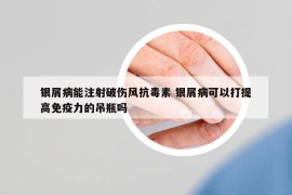 銀屑病能注射破傷風(fēng)抗毒素 銀屑病可以打提高免疫力的吊瓶嗎