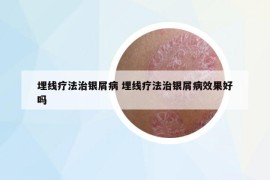 埋線療法治銀屑病 埋線療法治銀屑病效果好嗎