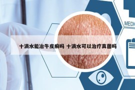 十滴水能冶牛皮癬嗎 十滴水可以治療真菌嗎