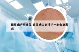 銀屑病產(chǎn)后爆發(fā) 銀屑病生完孩子一定會(huì)復(fù)發(fā)嗎