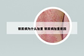 銀屑病為什么加重 銀屑病加重原因