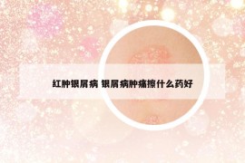 紅腫銀屑病 銀屑病腫痛擦什么藥好