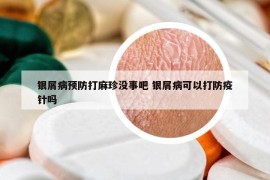 銀屑病預(yù)防打麻珍沒事吧 銀屑病可以打防疫針嗎