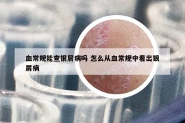 血常規(guī)能查銀屑病嗎 怎么從血常規(guī)中看出銀屑病