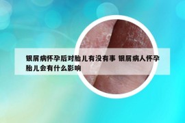 銀屑病懷孕后對(duì)胎兒有沒有事 銀屑病人懷孕胎兒會(huì)有什么影響