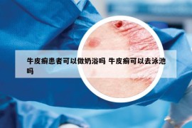 牛皮癬患者可以做奶浴嗎 牛皮癬可以去泳池嗎
