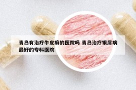 青島有治療牛皮癬的醫(yī)院嗎 青島治療銀屑病最好的?？漆t(yī)院