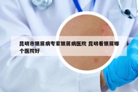 昆明市銀屑病專家銀屑病醫(yī)院 昆明看銀屑哪個醫(yī)院好