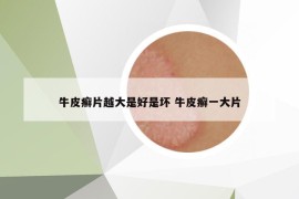 牛皮癬片越大是好是壞 牛皮癬一大片