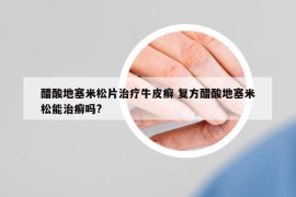 醋酸地塞米松片治療牛皮癬 復方醋酸地塞米松能治癬嗎?