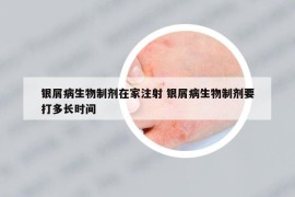 銀屑病生物制劑在家注射 銀屑病生物制劑要打多長時間