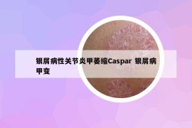銀屑病性關節(jié)炎甲萎縮Caspar 銀屑病甲變