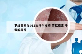羅紅霉素加b12治療牛皮癬 羅紅霉素 牛黃解毒片