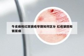 牛皮癬和紅斑狼瘡早期如何區(qū)分 紅瘡狼斑和銀屑病