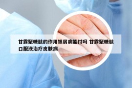 甘露聚糖肽的作用銀屑病能付嗎 甘露聚糖肽口服液治療皮膚病