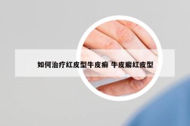 如何治療紅皮型牛皮癬 牛皮廨紅皮型