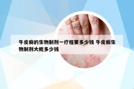 牛皮癬的生物制劑一療程要多少錢 牛皮癬生物制劑大概多少錢