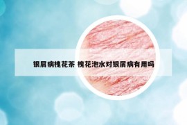 銀屑病槐花茶 槐花泡水對(duì)銀屑病有用嗎