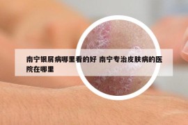 南寧銀屑病哪里看的好 南寧專(zhuān)治皮膚病的醫(yī)院在哪里