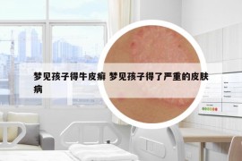 夢(mèng)見(jiàn)孩子得牛皮癬 夢(mèng)見(jiàn)孩子得了嚴(yán)重的皮膚病