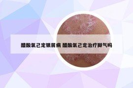 醋酸氯己定銀屑病 醋酸氯己定治療腳氣嗎